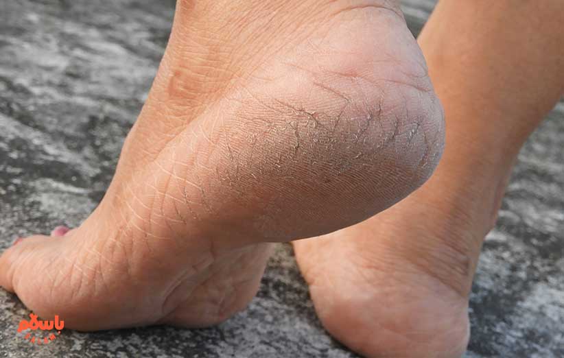 بهبود ترک پا