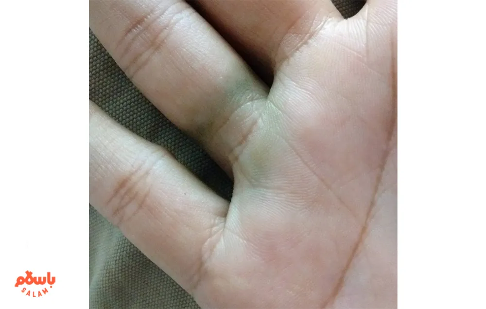 علت سبز شدن پوست با طلا