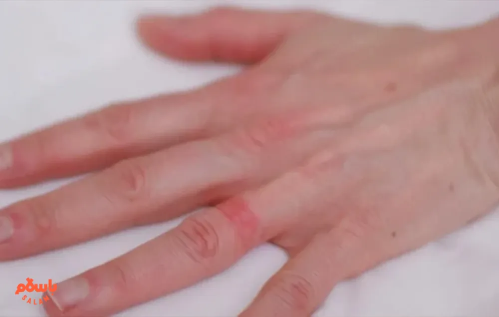 علائم حساسیت به طلا + راه های درمان و پیشگیری